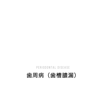 Periodontal disease 歯周病（歯槽膿漏）